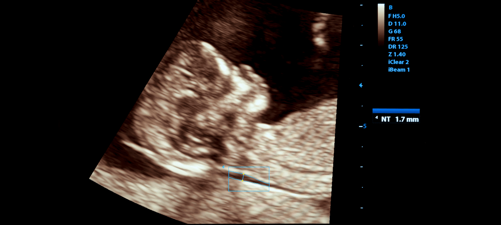 Nuchal Translucancy Screening | NT Scan