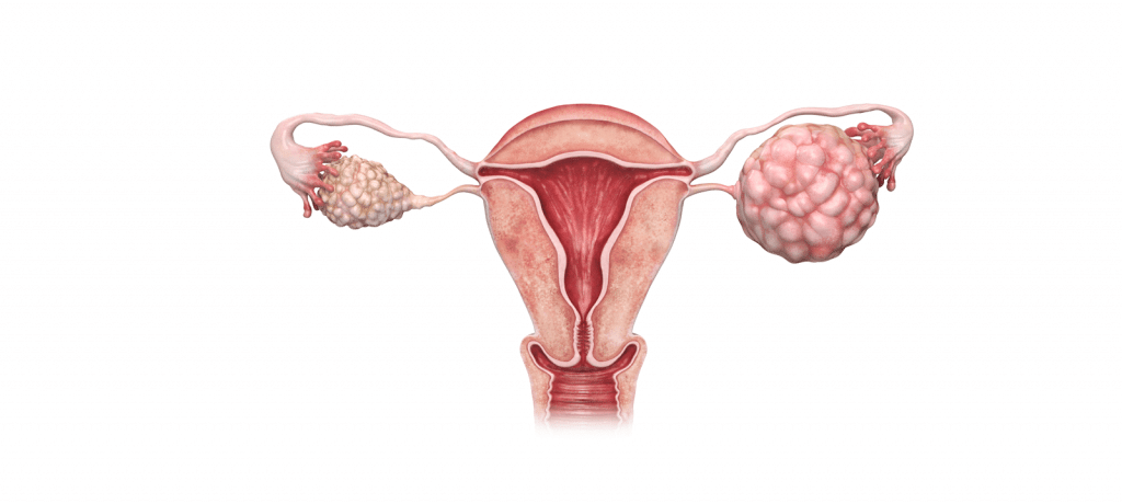 Ovarian Cancer Screening