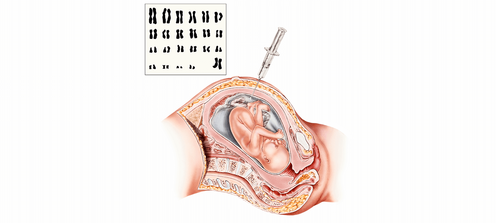 Amniocentesis Test