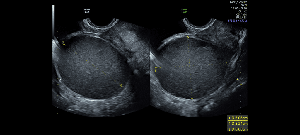 Endometriosis Screening gynaecological services Granville