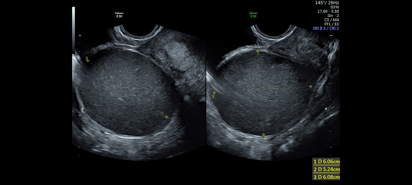 Endometriosis Ultrasound & Staging
