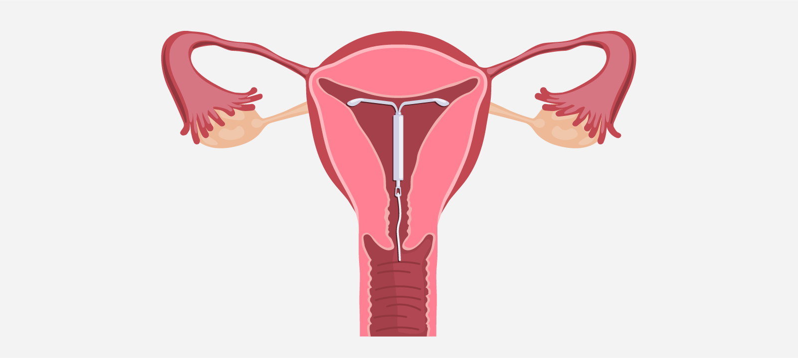 Mirena Insertion & Removal