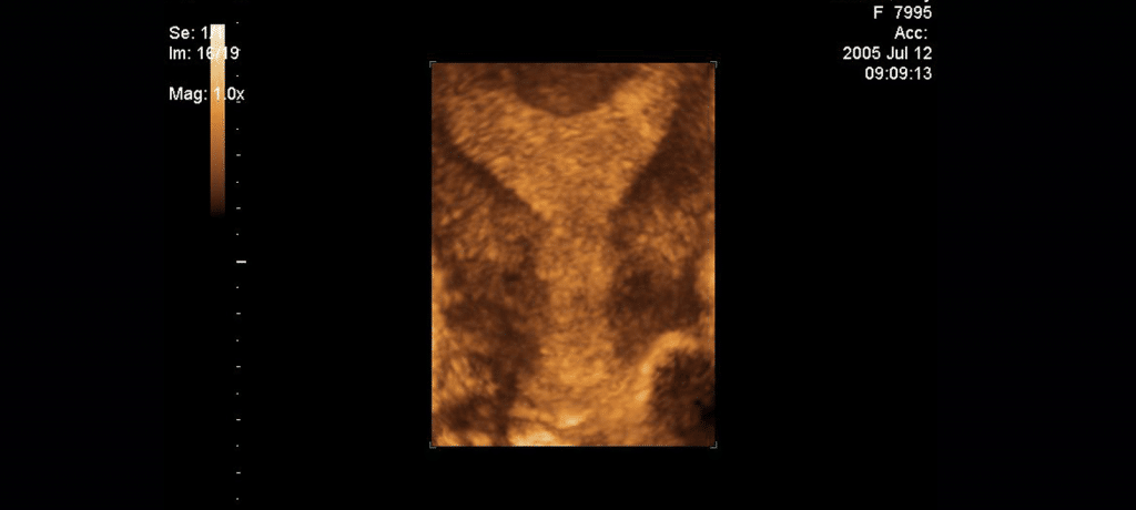 Sonohysterogram Gynaecological Services Kingswood