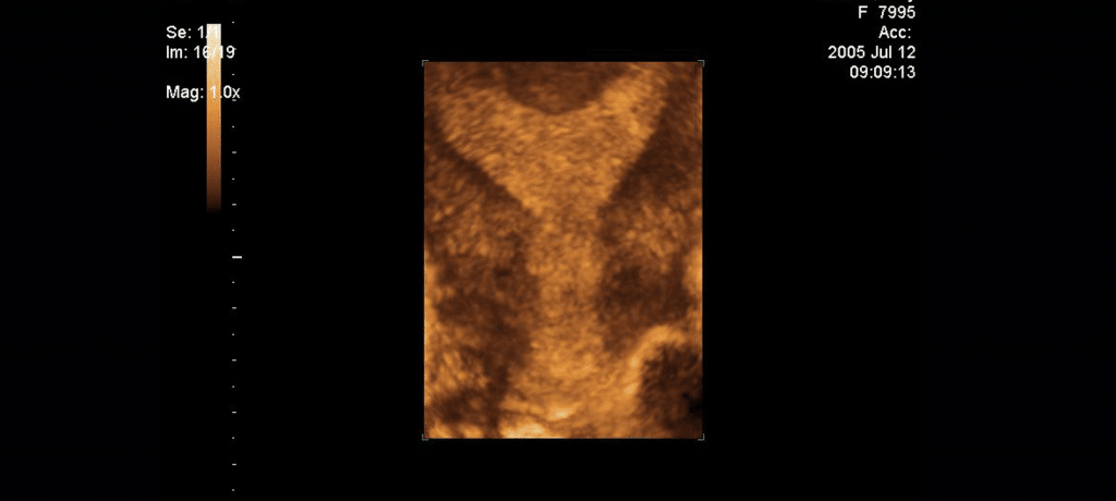 Sonohysterogram Carlingford